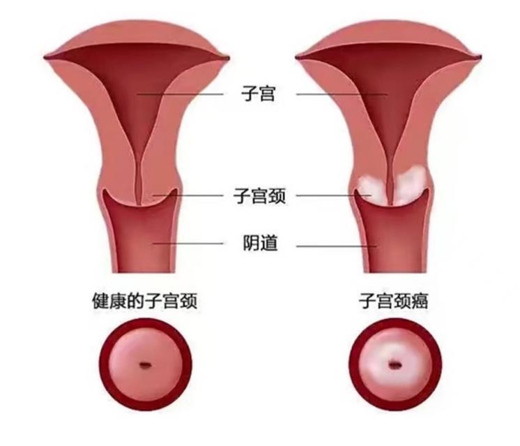 宫颈癌_宫颈癌检查 - 好大夫在线