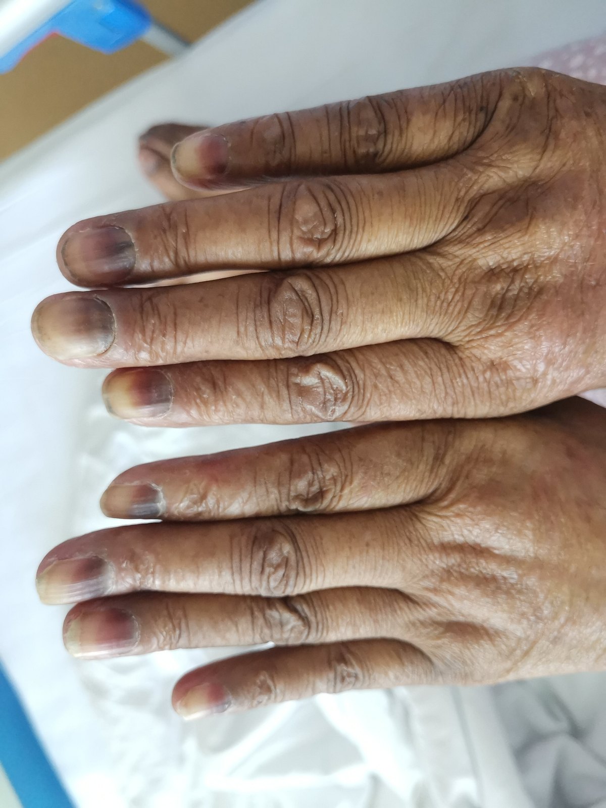 乳腺癌化疗后出现手足综合征怎么办?_化疗_化疗治疗介绍 - 好大夫在线