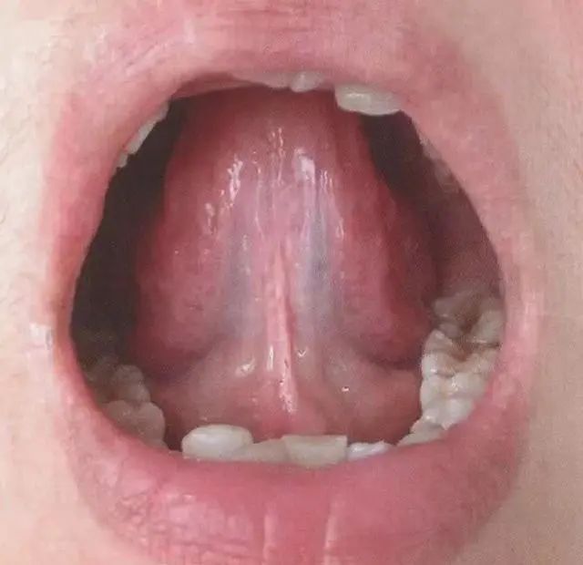 舌下络脉 好大夫在线 舌下络脉 好大夫在线