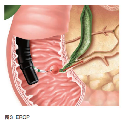 ercp手术示意图图片