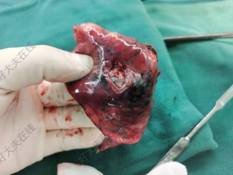 肺下叶7毫米磨玻璃结节,通过术前ct,考虑微浸润腺癌,建议直接手术切除