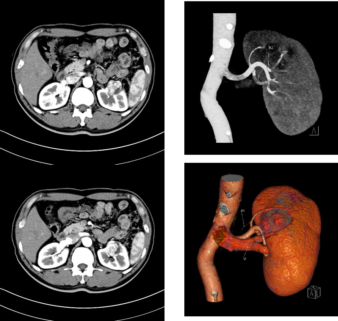 大体积肾肿瘤内生型肿瘤肾门型肿瘤如何做保肾手术
