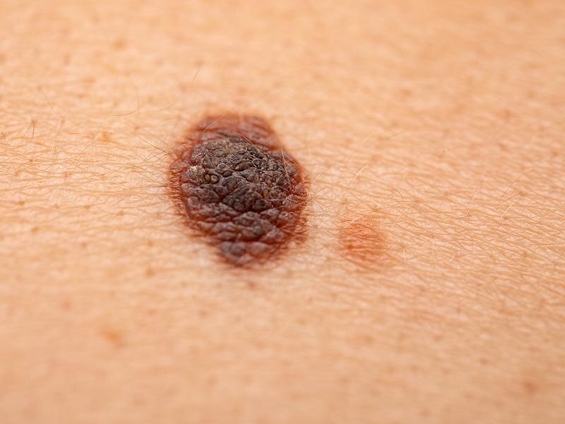 Malignant-melanoma-Large-5-1.jpg