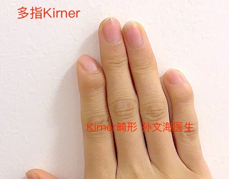 多指Kirner3的副本2.JPG