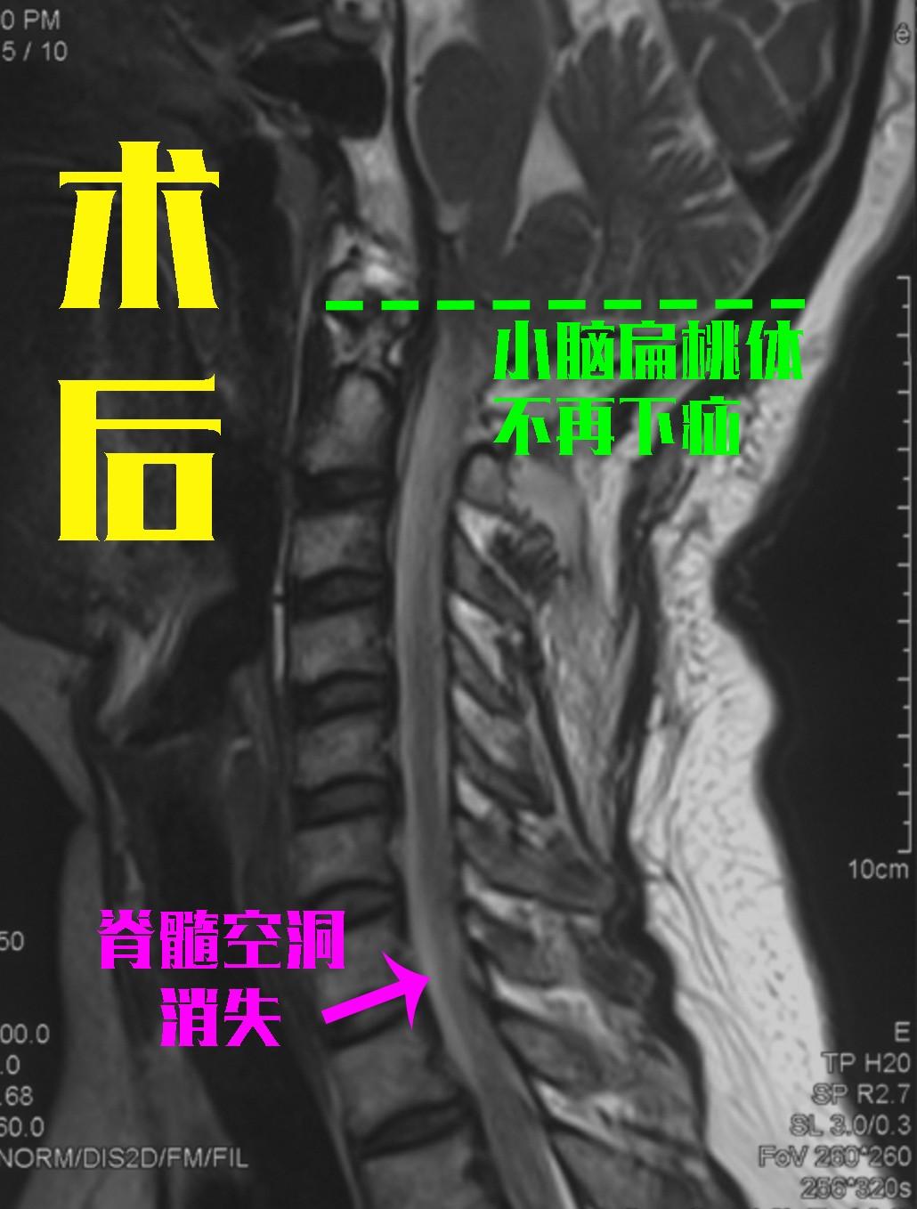 请问什么叫脊髓空洞 1oYBAGb35giAbRd9AAG2eplW_AU455.png?_ms_=5276