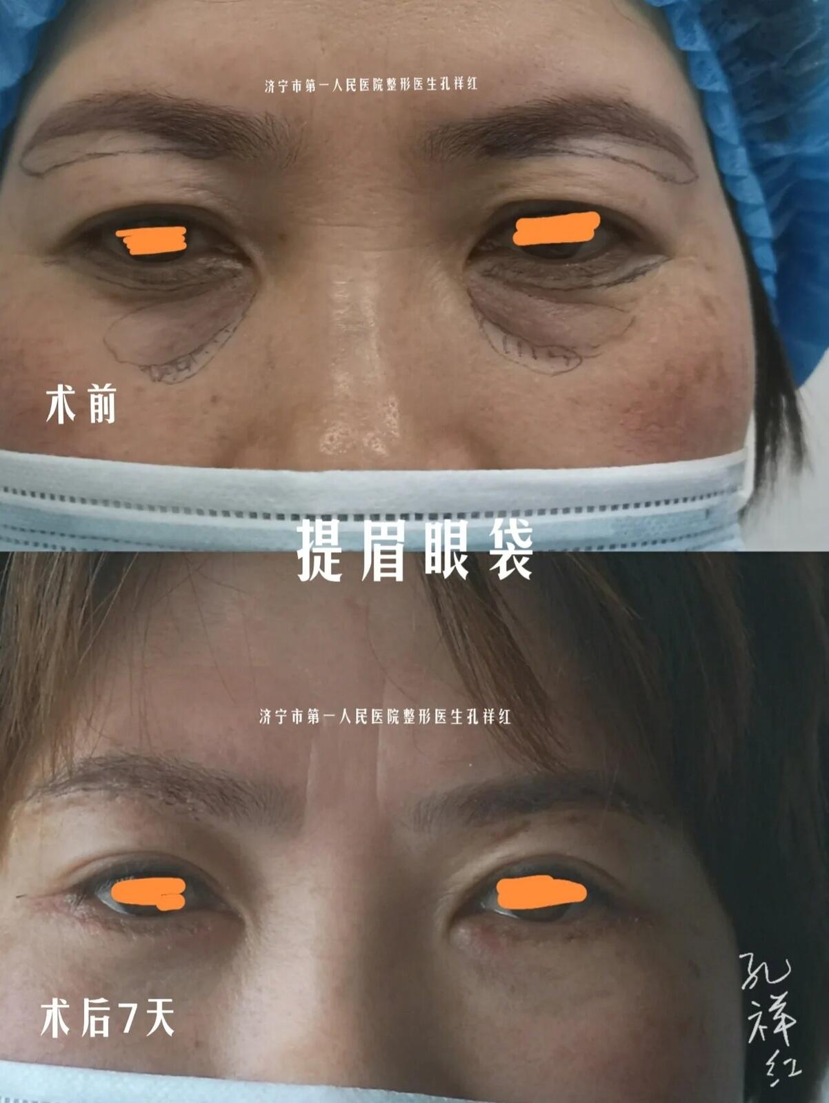 北京全切双眼皮 眼轮匝肌瓣 眶隔脂肪释放 术后九个月 - 知乎