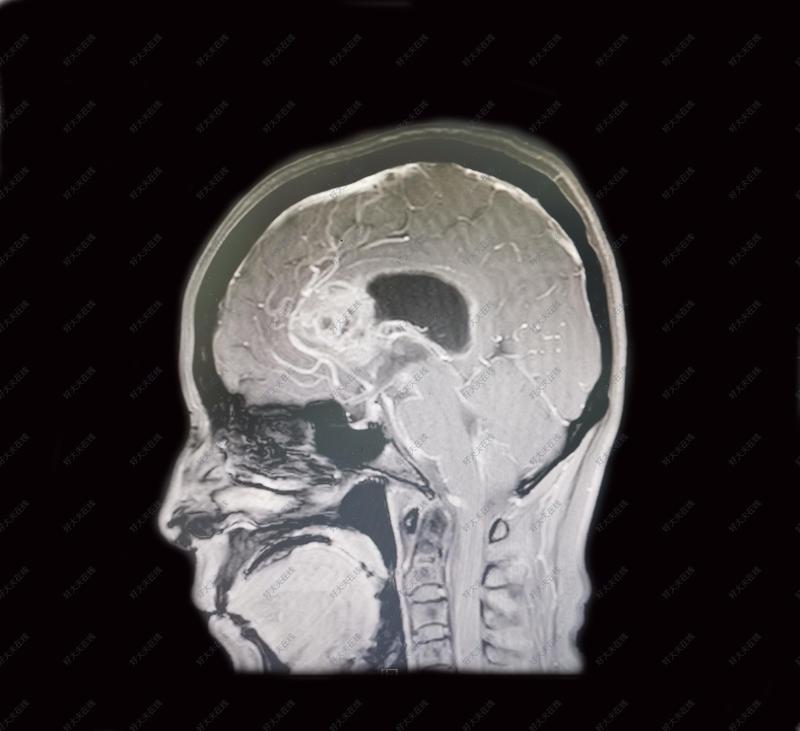 双额叶胼胝体胶质瘤_胶质瘤 - 好大夫在线