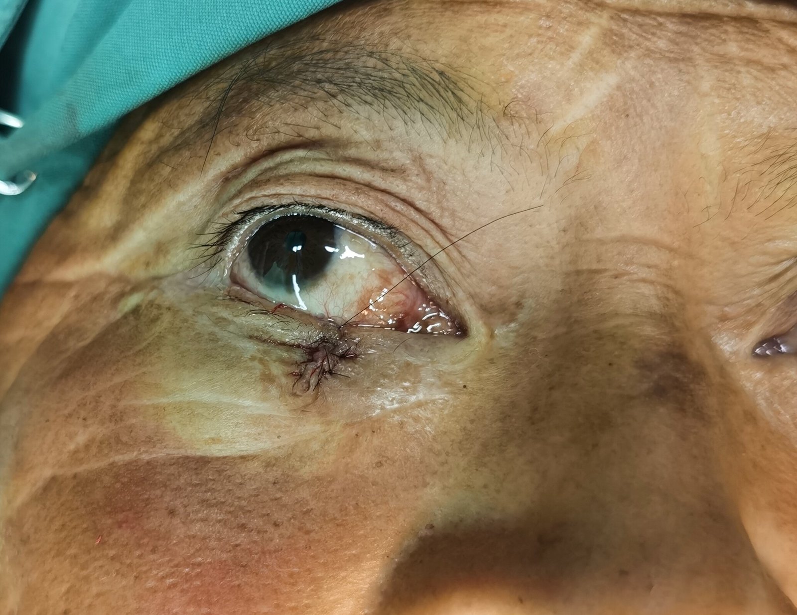 眼睑长了犄角怎么办---皮角的治疗 - 好大夫在线