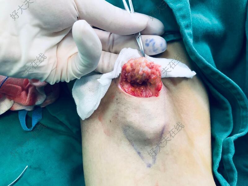 号的文章/病例】惠州市中心人民医院整形创伤(显微)外科