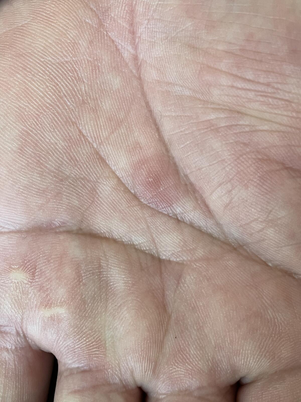 梅毒手部症状图片图片