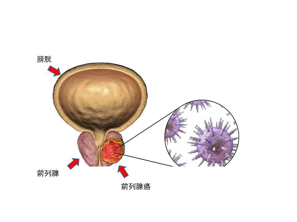 人体前列腺癌图片图片