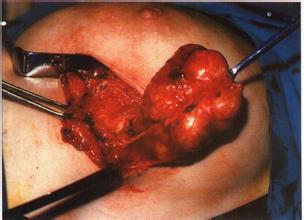 你的乳腺有纤维瘤吗? - 好大夫在线