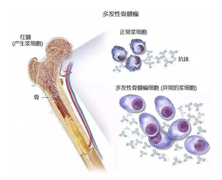 多发性骨髓瘤