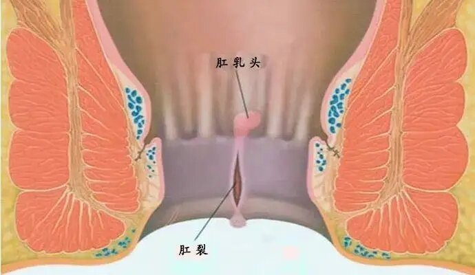 肛周软纤维瘤图片