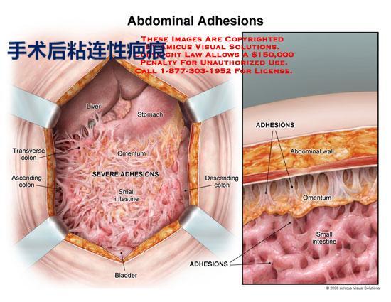 Adhesions 粘连.jpg