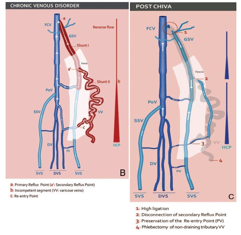 下肢静脉曲张手术图解图片