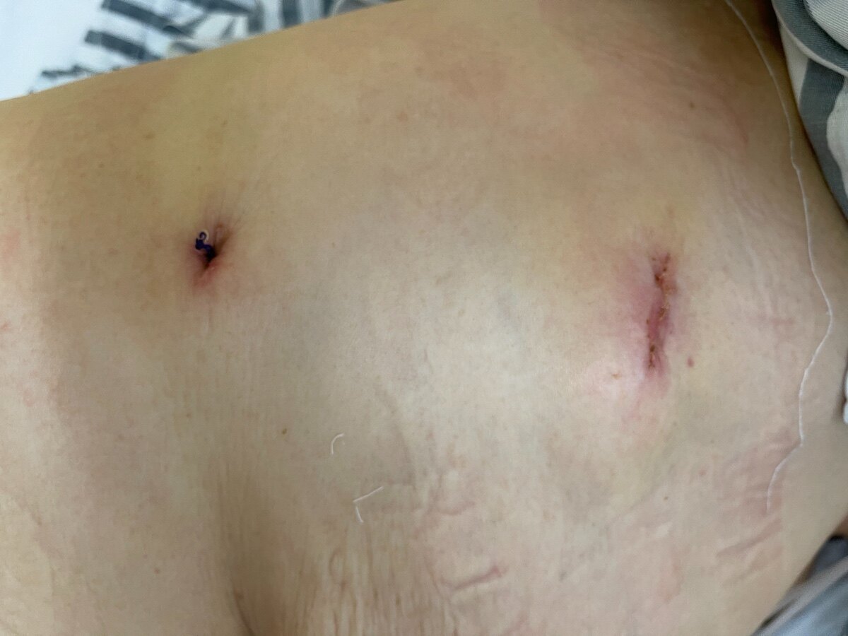 肺结节手术伤疤图片图片
