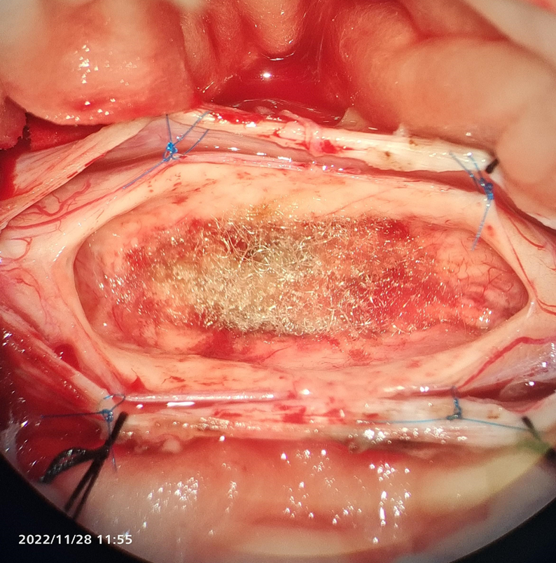 恶性室管膜瘤图片