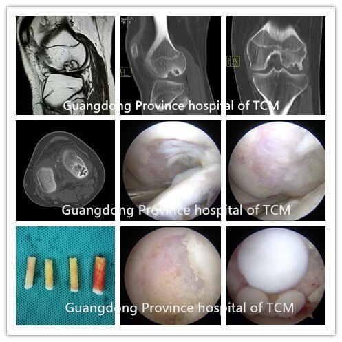 我信赖的自体骨软骨移植术广东省中医院杨伟铭