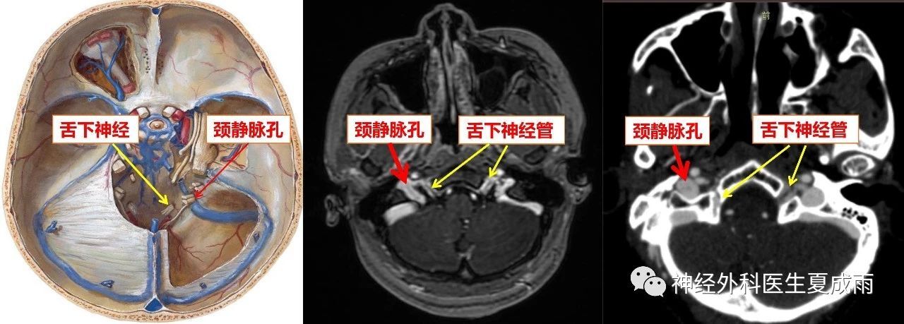 的腫瘤罕見,最常見的腫瘤為神經鞘瘤,其次為腦膜瘤,少見為頸靜脈球瘤