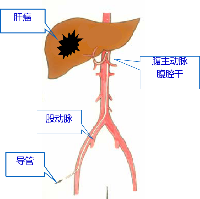 肝癌是起源於肝細胞的富血供惡性腫瘤,90%以上的血供來自肝動脈.