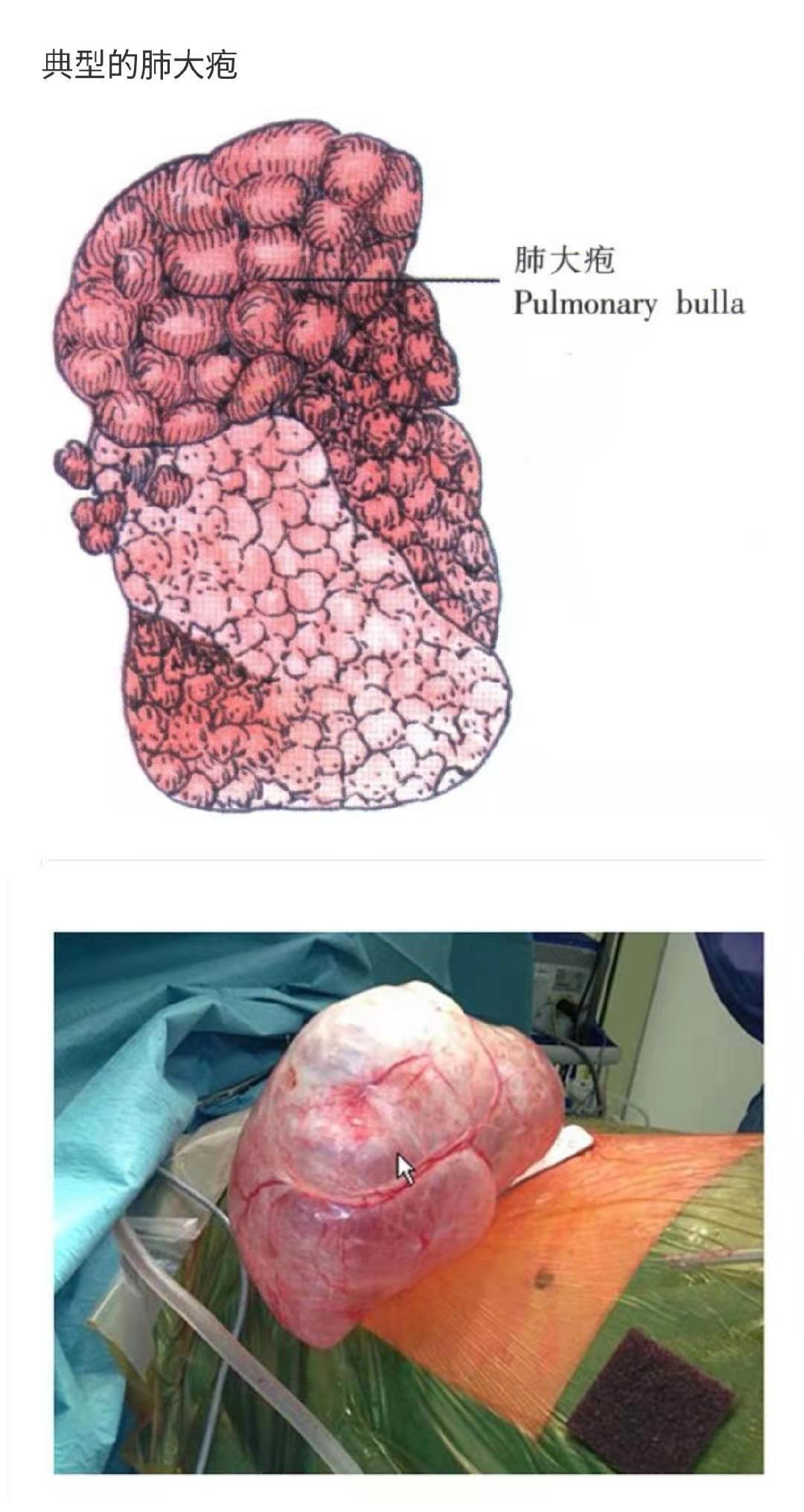 肺大泡和气胸需要手术吗 气胸 气胸治疗方式 好大夫在线