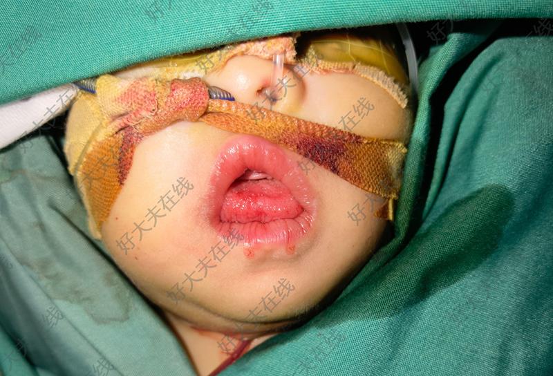 淋巴管瘤_口腔颌面部血管瘤 - 好大夫在线