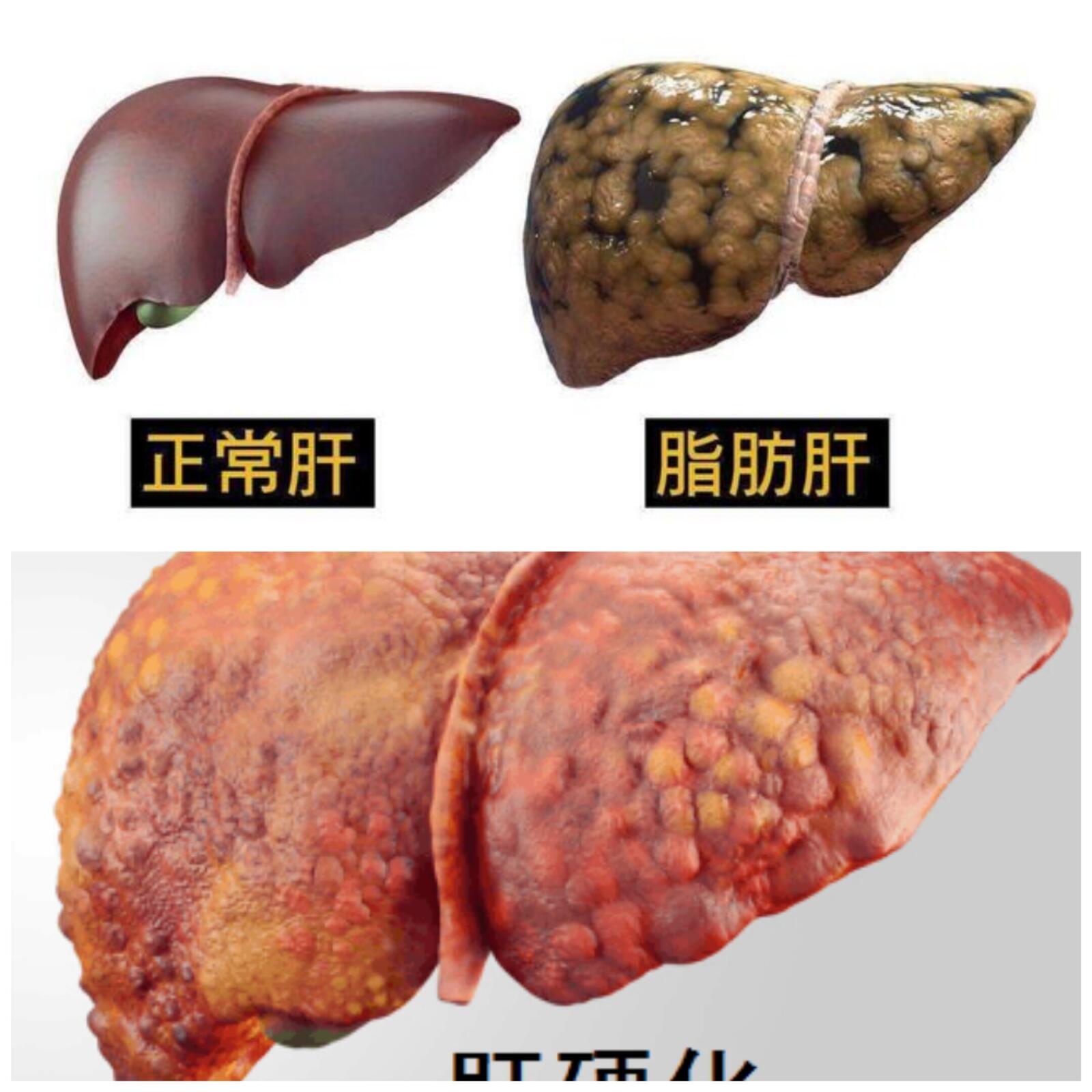 奥贝胆酸何时进入中国图片