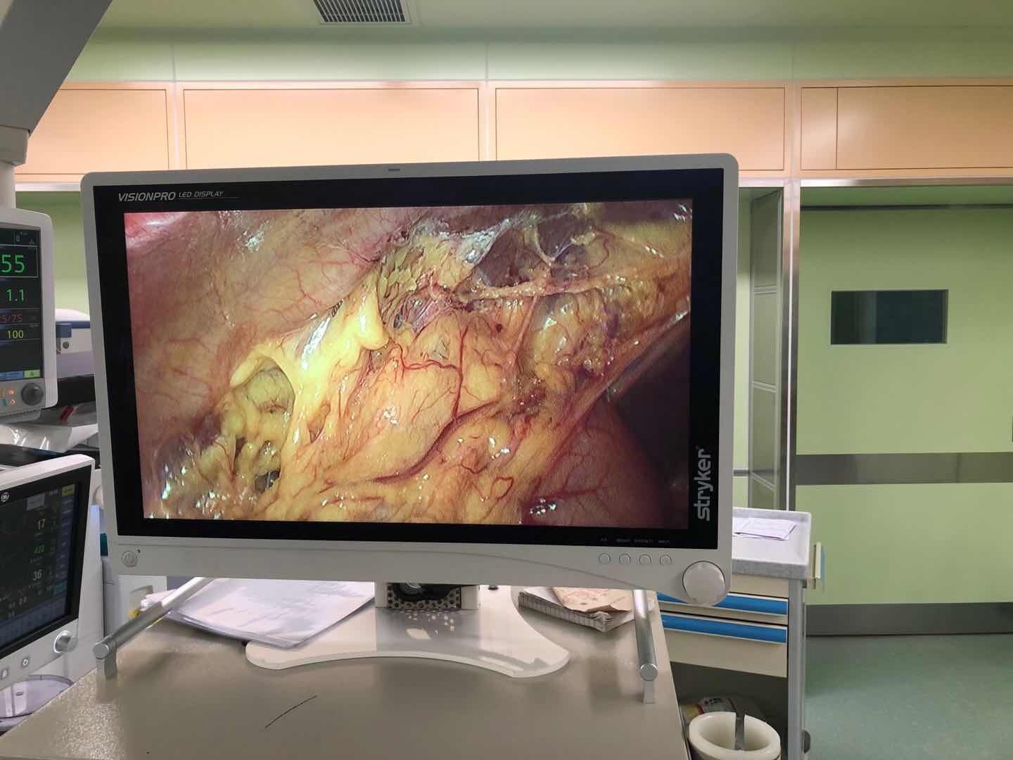 腹腔镜肝切除治疗转移性肝癌术后复发_肝癌_肝癌治疗方式 - 好大夫