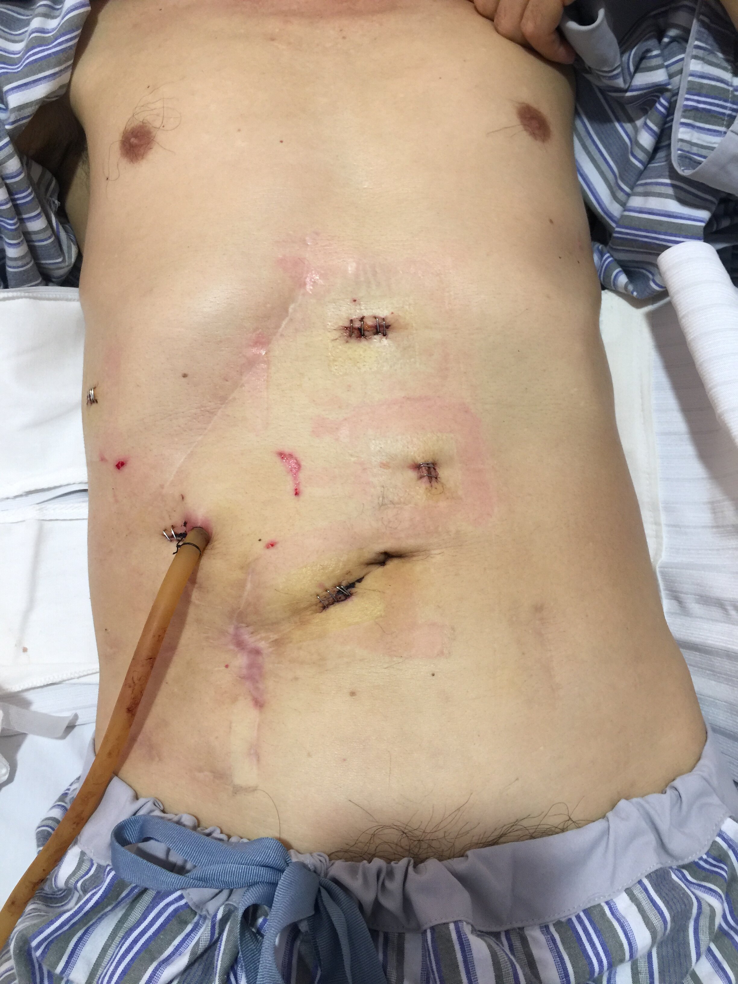 腹腔镜肝切除治疗转移性肝癌术后复发
