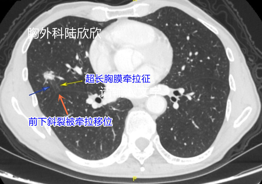 薄层165超长胸膜牵拉征水印.jpg