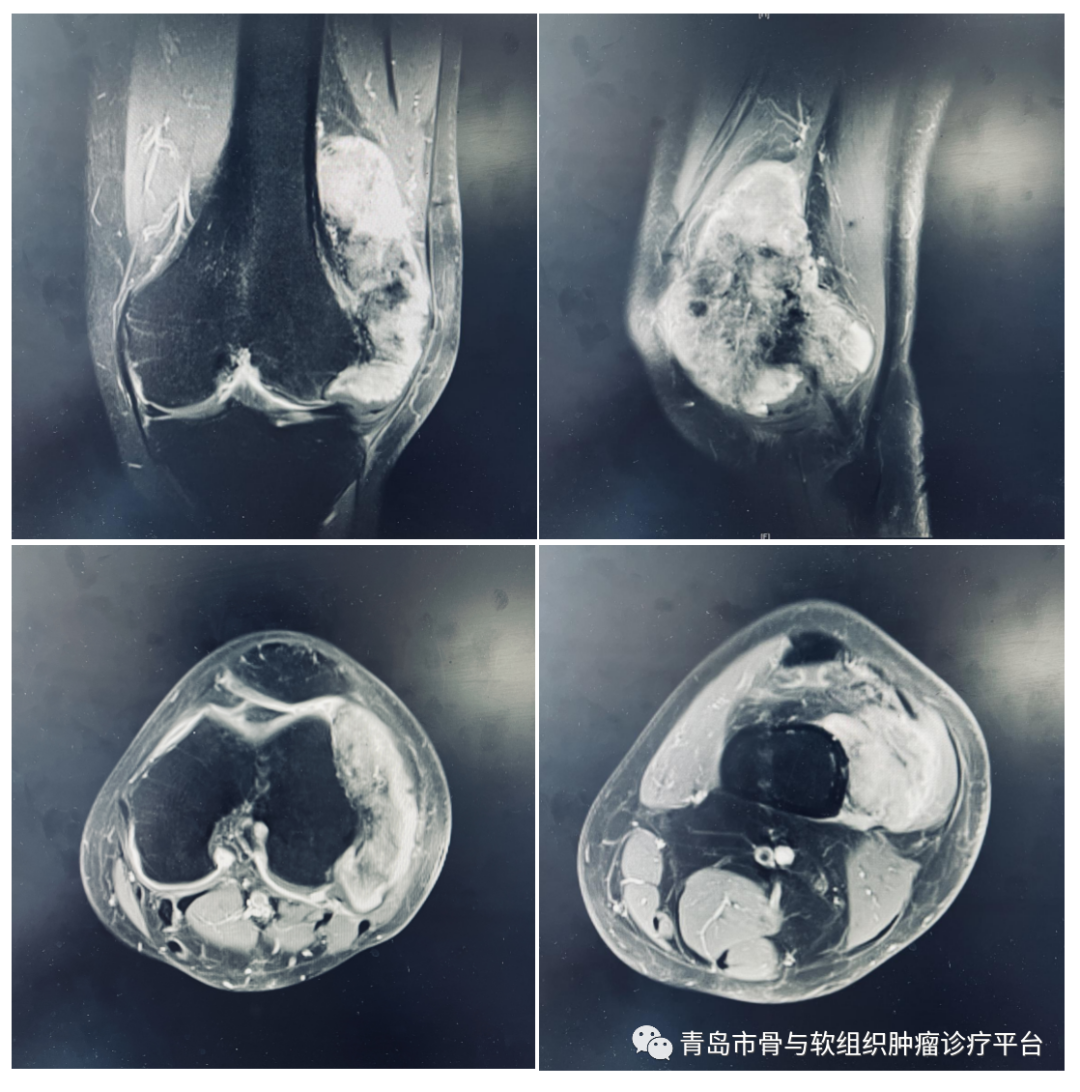 膝盖肿瘤图片