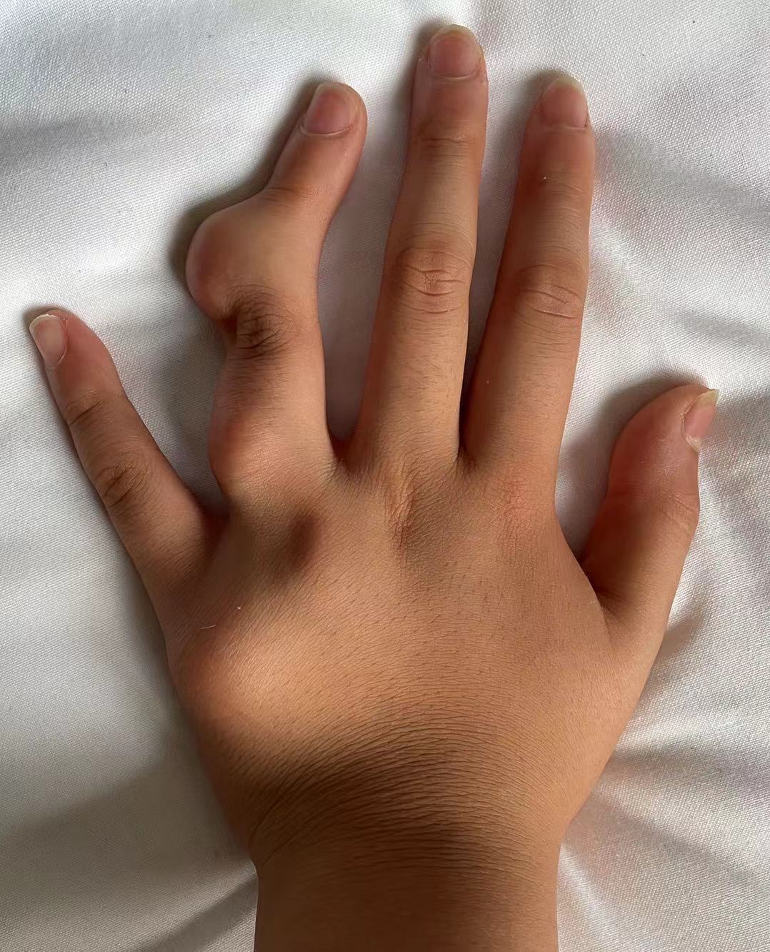 手指软骨瘤图片