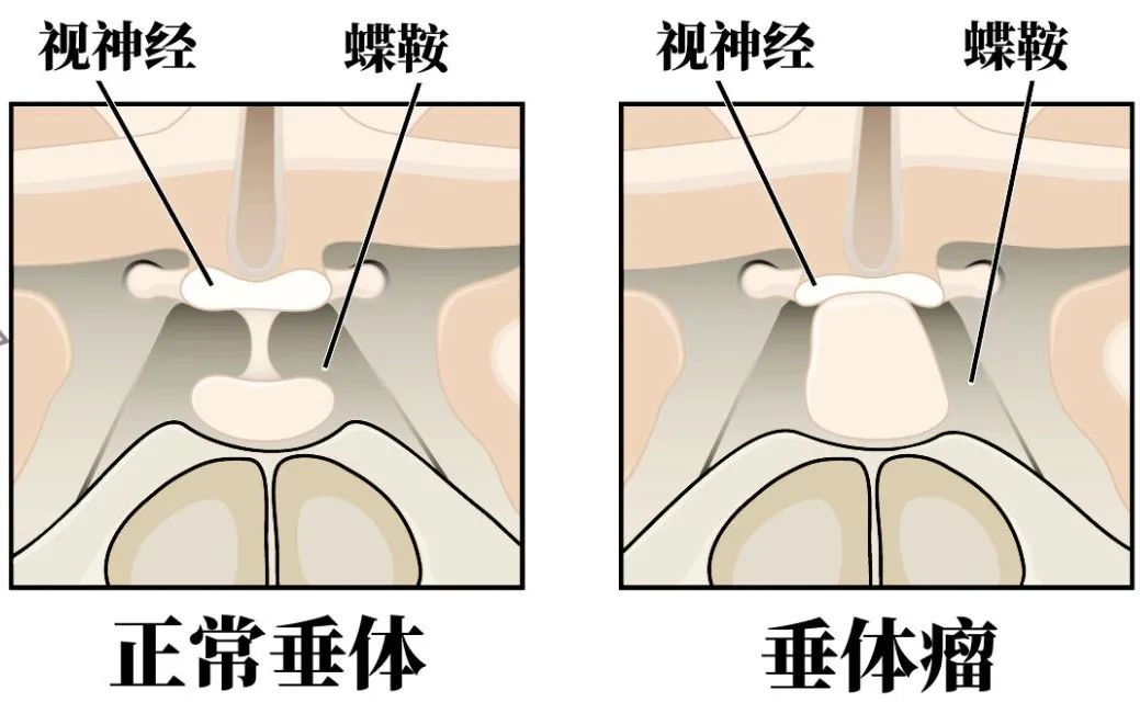 脑垂体图片位置图片