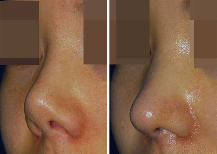 做膨体鼻,就会感染,回缩?错误!