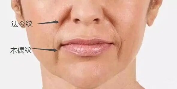 木偶纹或称流涎纹,长在嘴角两侧的深弧凹陷,看起来像木偶嘴边的两条
