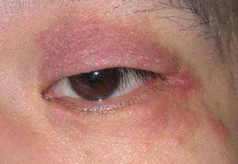 过敏性眼睑皮肤炎最常见的,它是一种由内外因素引起的具有明显渗出或