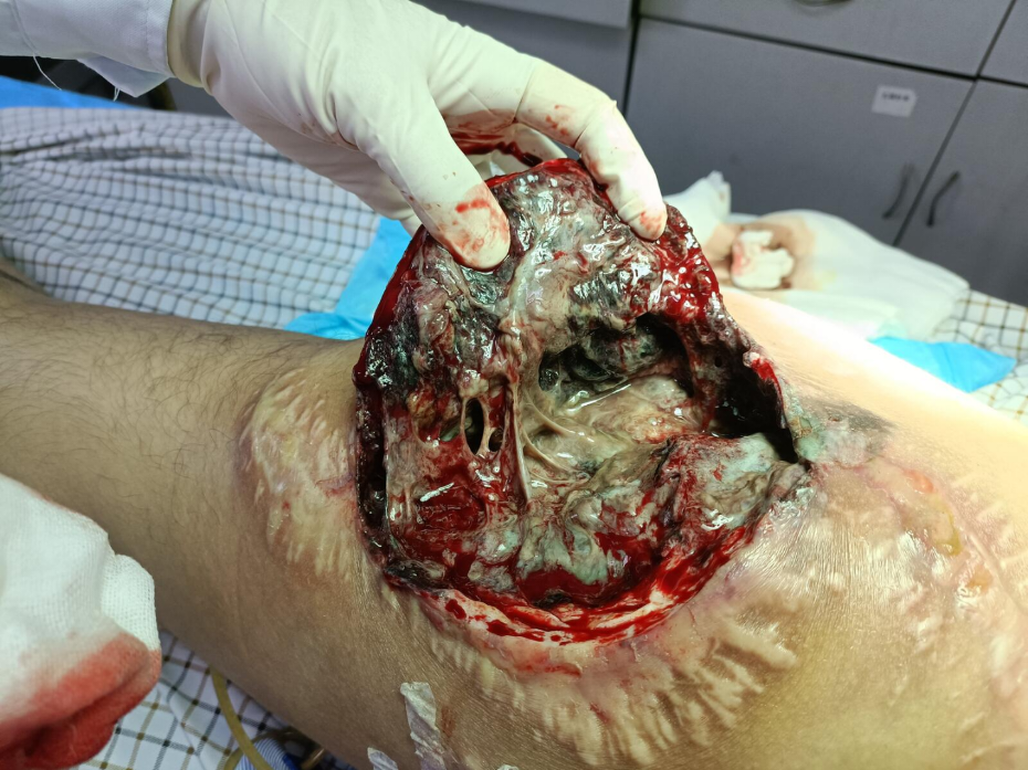 明显好转,2周后探查见坏死组织明显减少创面由黑转红再次给于清创治疗