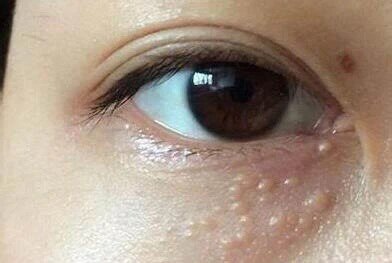 女性眼部汗管瘤图片图片