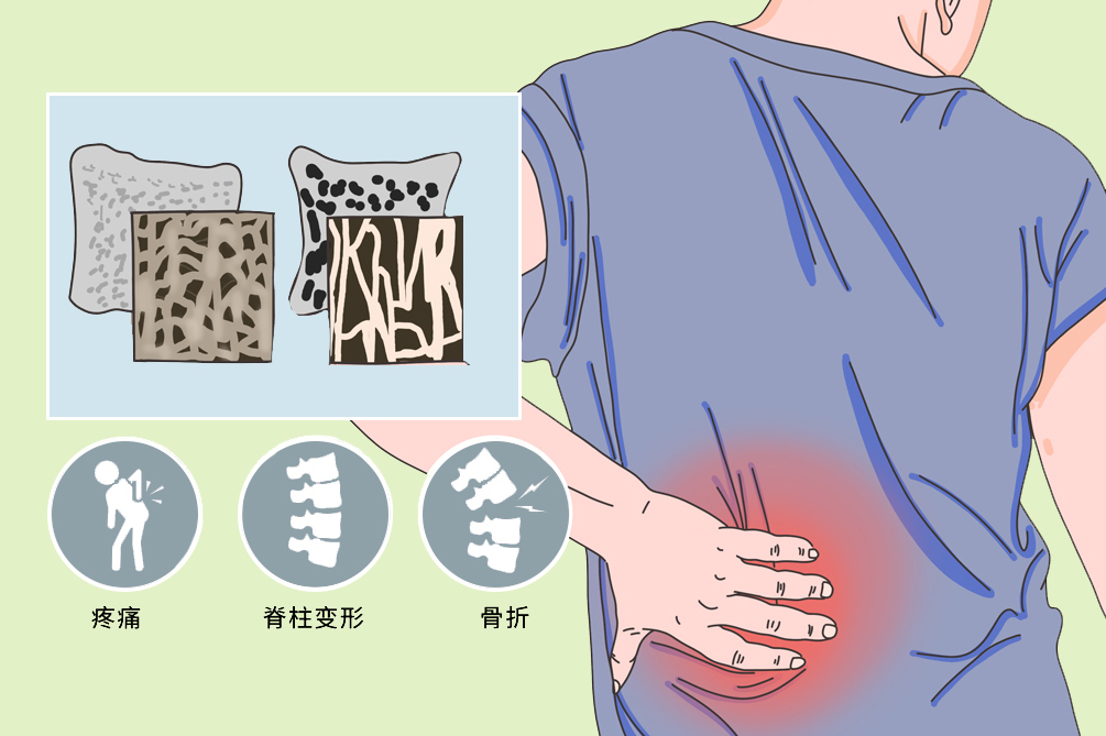 针灸何以治疗骨质疏松症? - 好大夫在线