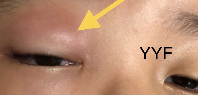 眼眶炎性假瘤的激素治疗&历时四年多的减量之路&治疗成功的关键.