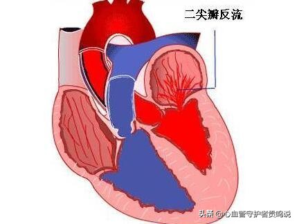 前几天因为心慌到医院检查说是二尖瓣关闭不全这种病是怎么得的