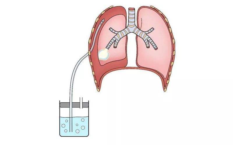 醫學科普:月經性氣胸_氣胸_介紹_症狀表現_檢查_治療方式_日常注意