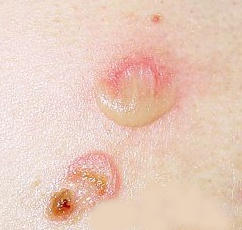 生殖疱疹有什么症状呢图片