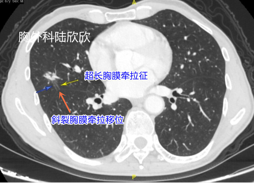 薄层167超长胸膜牵拉征水印.jpg