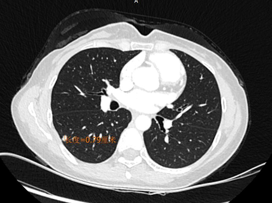 肺部ct表现为实性结节的可能性疾病之一:从症状到诊断和治疗_肺部结节