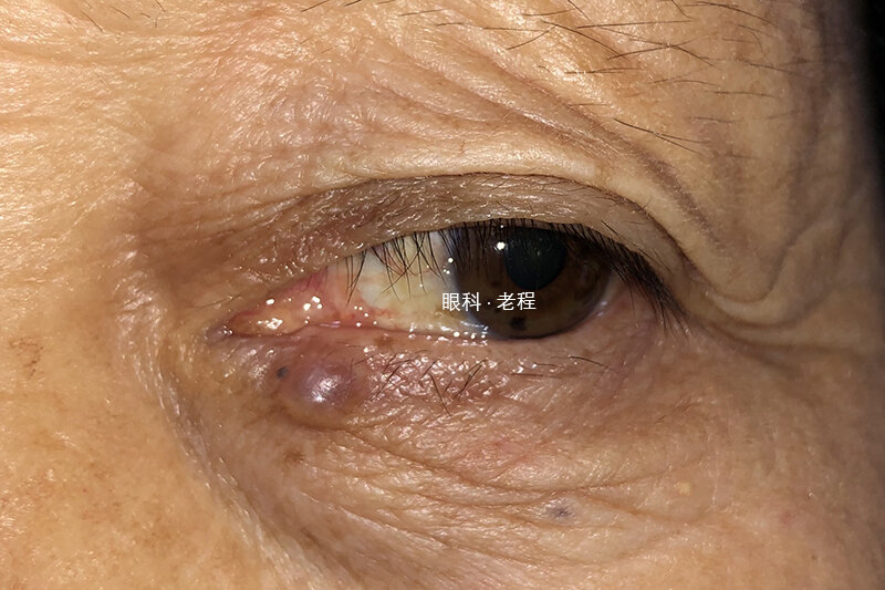眼癌的早期症状图片图片