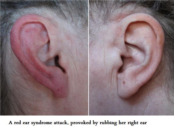 Red Ear Syndrome.jpg