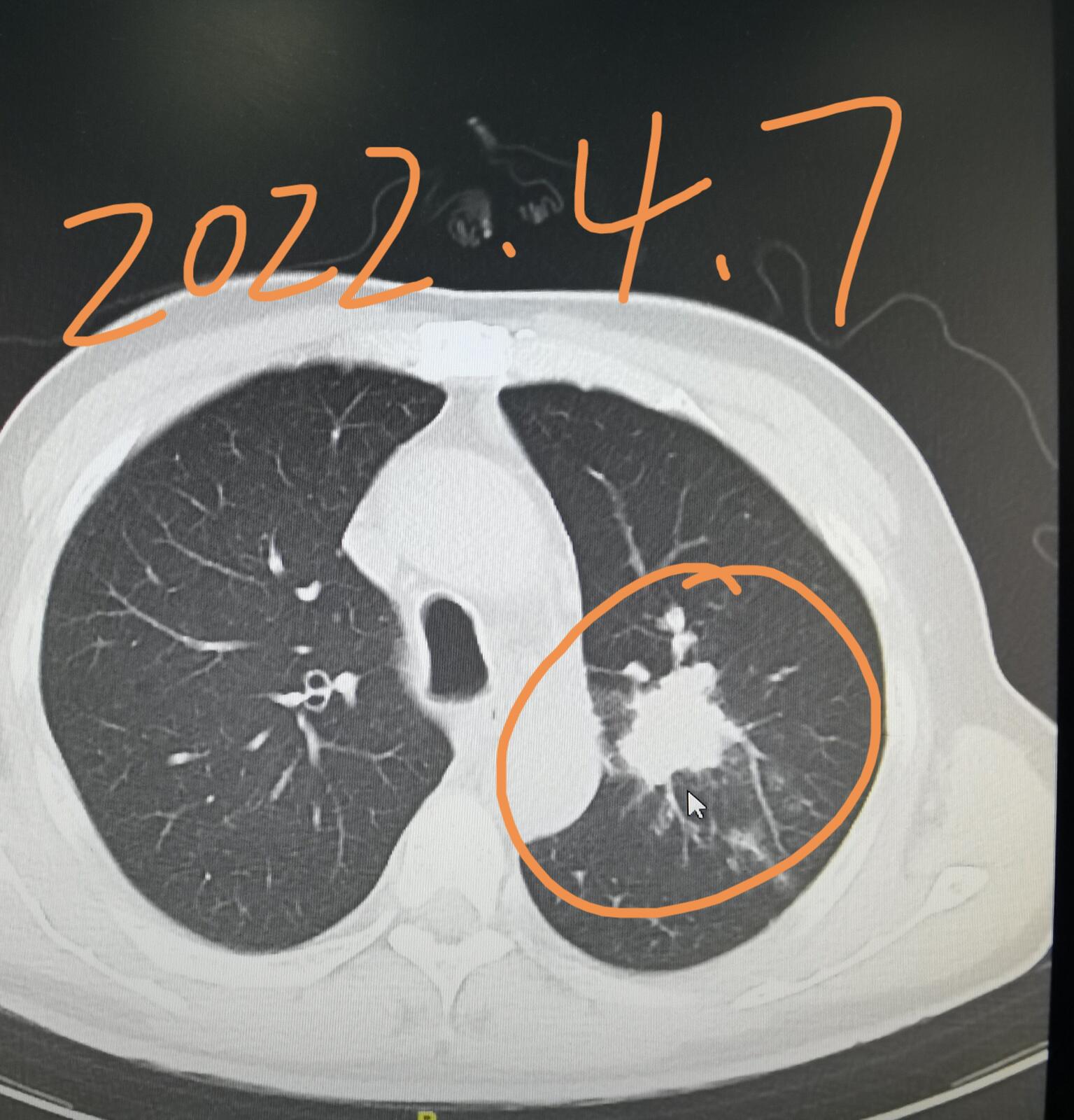 刘懿博士说肺癌三七〇四胸片发现问题没重视肺癌耽误了八个月