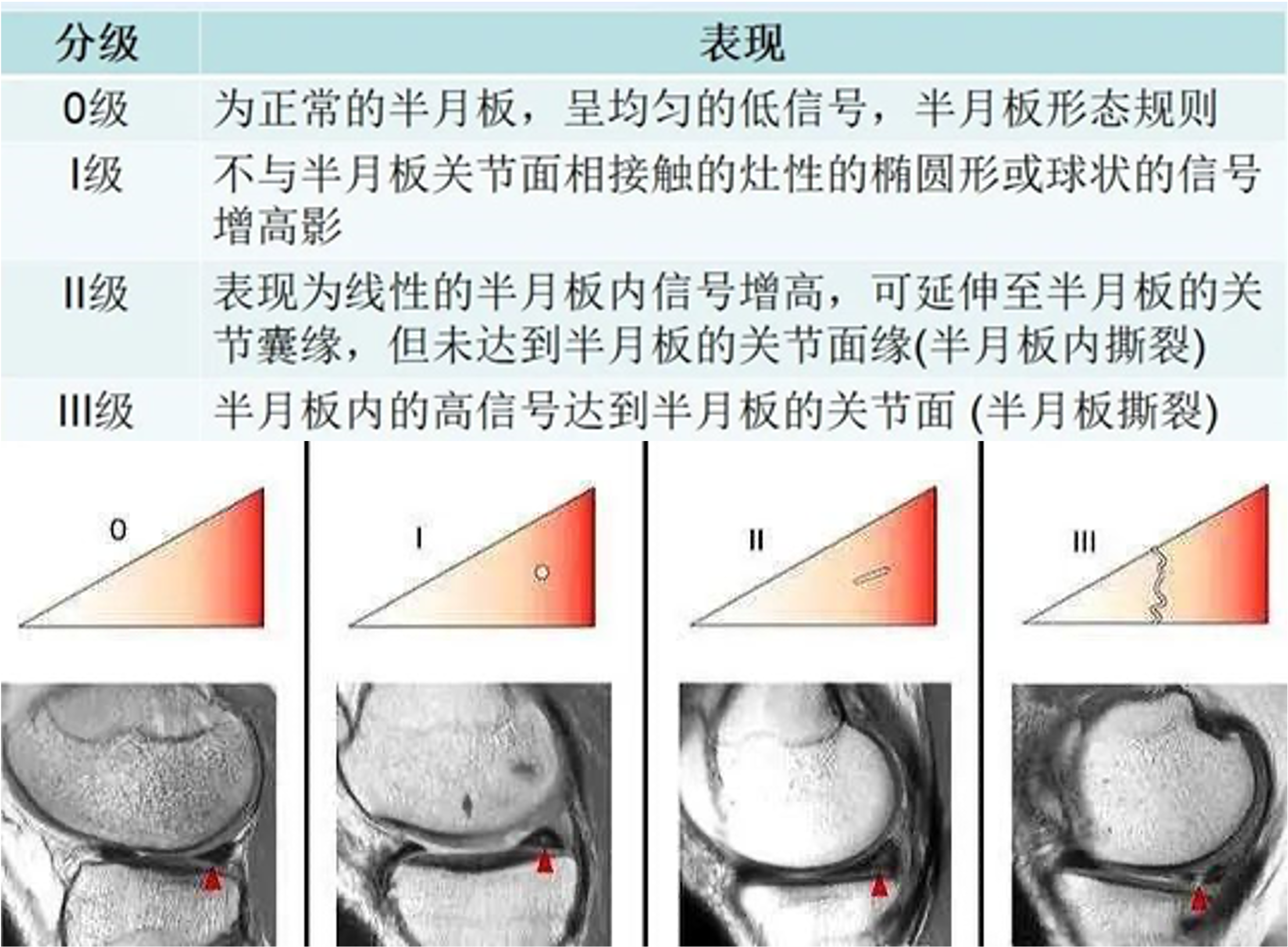 半月板分级.png